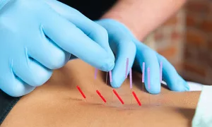 Dry needling therapy serving Northern VA and DC area.